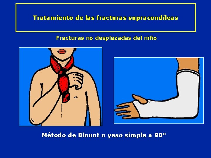 Tratamiento de las fracturas supracondíleas Fracturas no desplazadas del niño Método de Blount o