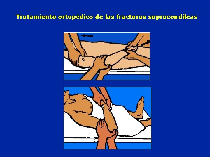 Tratamiento ortopédico de las fracturas supracondíleas 
