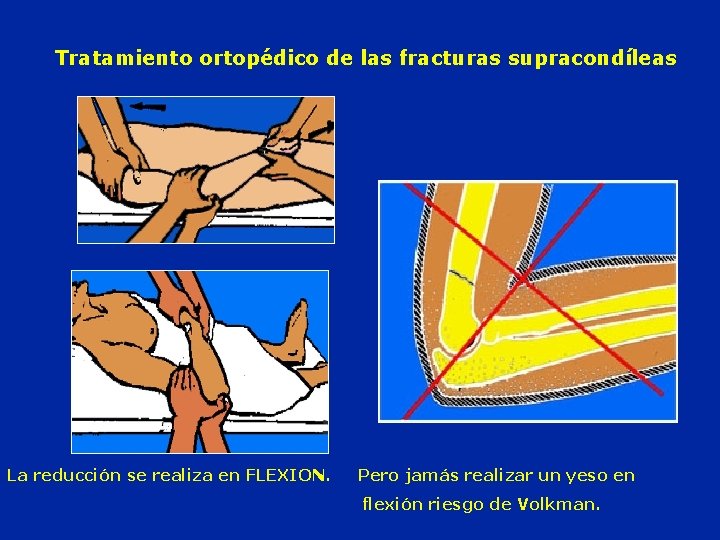 Tratamiento ortopédico de las fracturas supracondíleas La reducción se realiza en FLEXION. Pero jamás