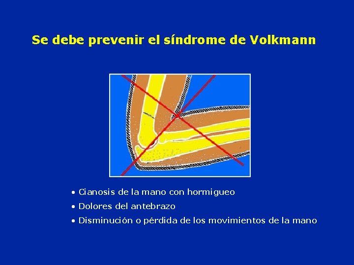 Se debe prevenir el síndrome de Volkmann • Cianosis de la mano con hormigueo