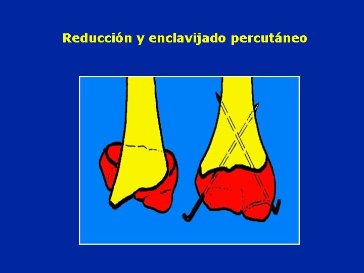 Reducción y enclavijado percutáneo 