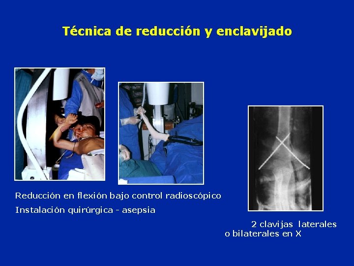 Técnica de reducción y enclavijado Reducción en flexión bajo control radioscópico Instalación quirúrgica -