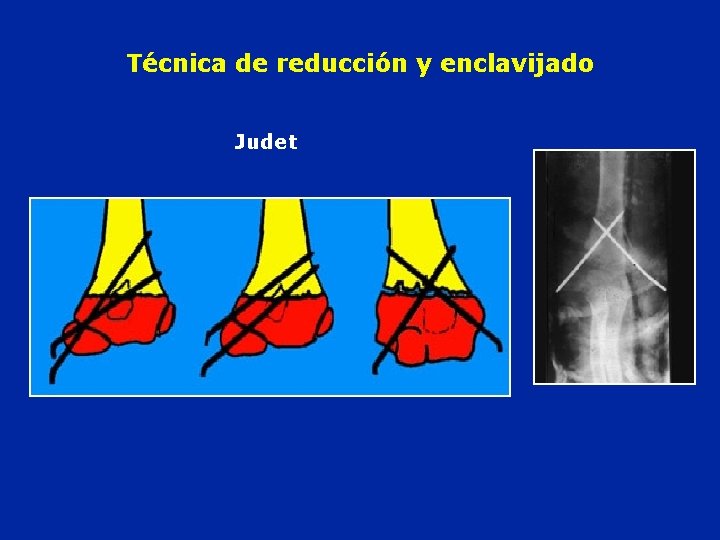 Técnica de reducción y enclavijado Judet 