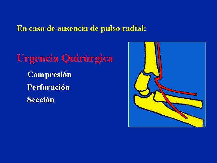 En caso de ausencia de pulso radial: Urgencia Quirúrgica Compresión Perforación Sección 