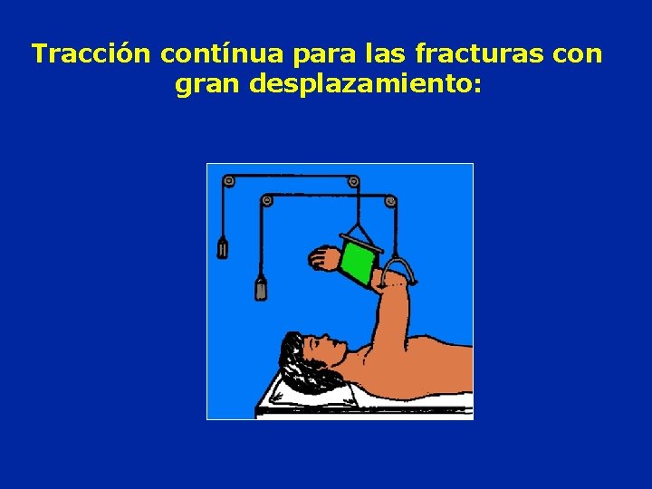 Tracción contínua para las fracturas con gran desplazamiento: 
