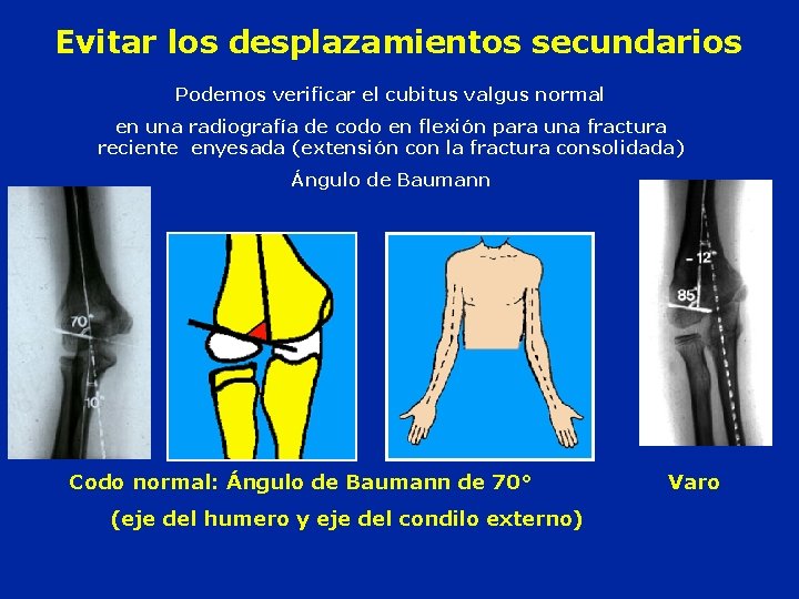Evitar los desplazamientos secundarios Podemos verificar el cubitus valgus normal en una radiografía de