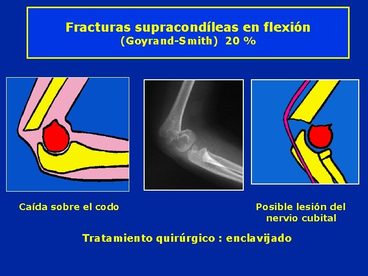 Fracturas supracondíleas en flexión (Goyrand-Smith) 20 % Caída sobre el codo Posible lesión del