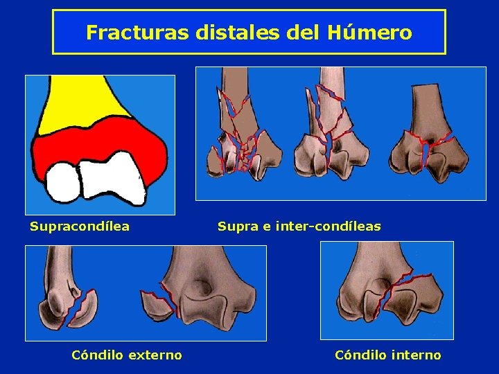 Fracturas distales del Húmero Supracondílea Cóndilo externo Supra e inter-condíleas Cóndilo interno 