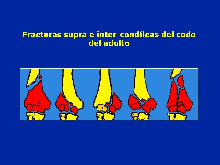Fracturas supra e inter-condíleas del codo del adulto 