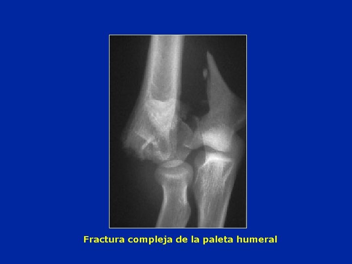 Fractura compleja de la paleta humeral 