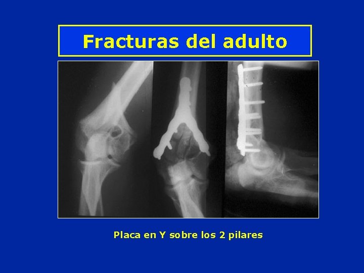 Fracturas del adulto Placa en Y sobre los 2 pilares 