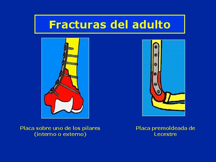 Fracturas del adulto Placa sobre uno de los pilares (interno o externo) Placa premoldeada