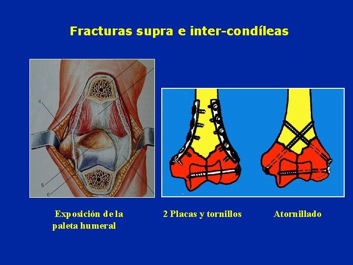 Fracturas supra e inter-condíleas Exposición de la paleta humeral 2 Placas y tornillos Atornillado