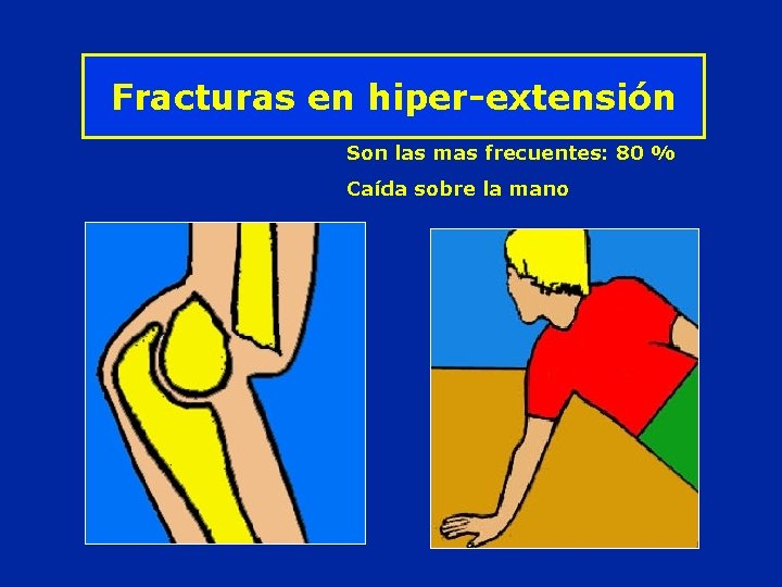 Fracturas en hiper-extensión Son las mas frecuentes: 80 % Caída sobre la mano 