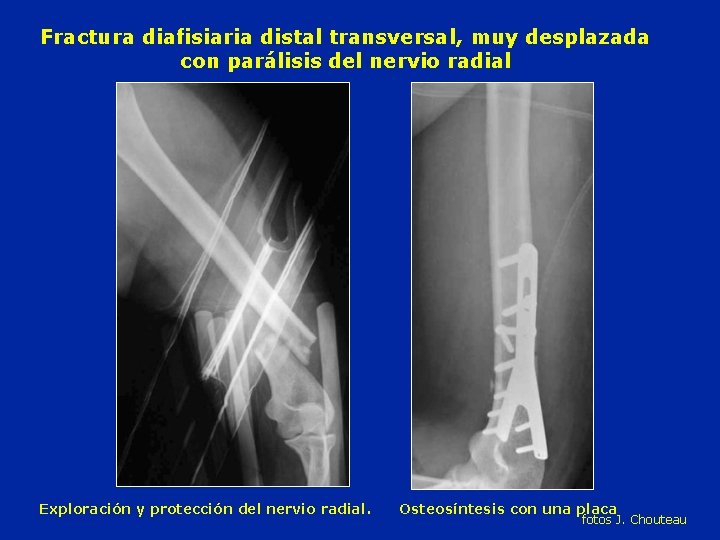 Fractura diafisiaria distal transversal, muy desplazada con parálisis del nervio radial Exploración y protección