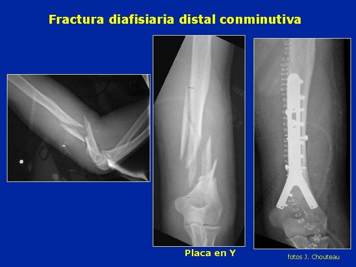 Fractura diafisiaria distal conminutiva Placa en Y fotos J. Chouteau 