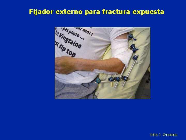 Fijador externo para fractura expuesta fotos J. Chouteau 