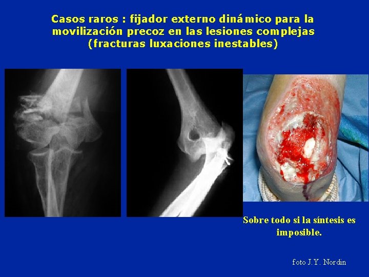 Casos raros : fijador externo dinámico para la movilización precoz en las lesiones complejas