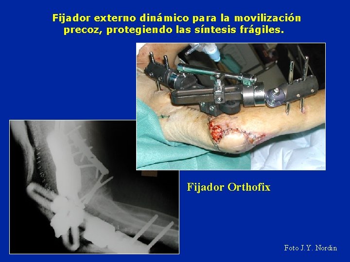 Fijador externo dinámico para la movilización precoz, protegiendo las síntesis frágiles. Fijador Orthofix Foto