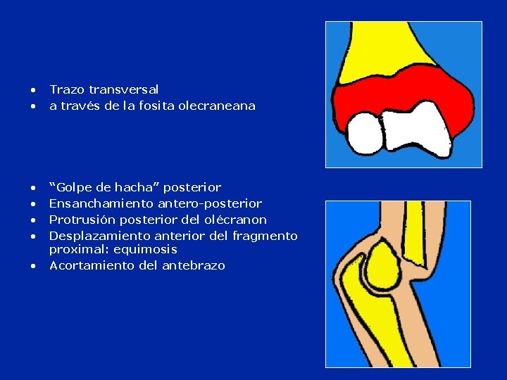  • • Trazo transversal a través de la fosita olecraneana • • “Golpe