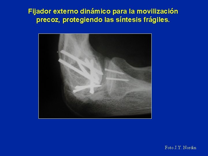 Fijador externo dinámico para la movilización precoz, protegiendo las síntesis frágiles. Foto J. Y.