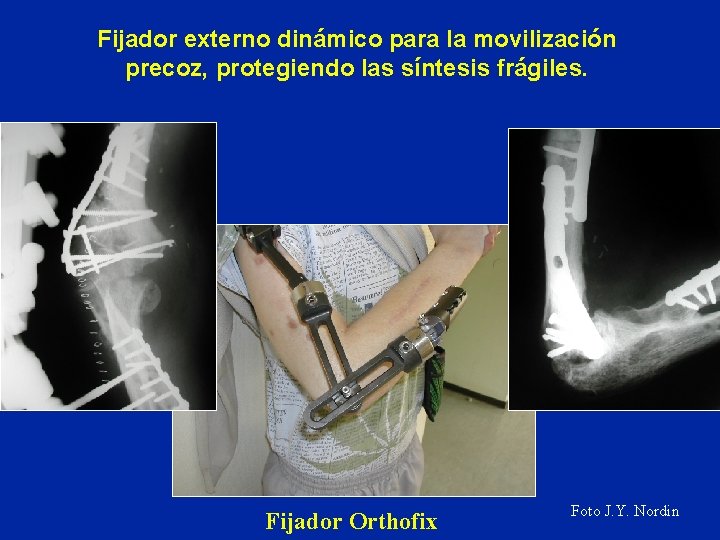 Fijador externo dinámico para la movilización precoz, protegiendo las síntesis frágiles. Fijador Orthofix Foto