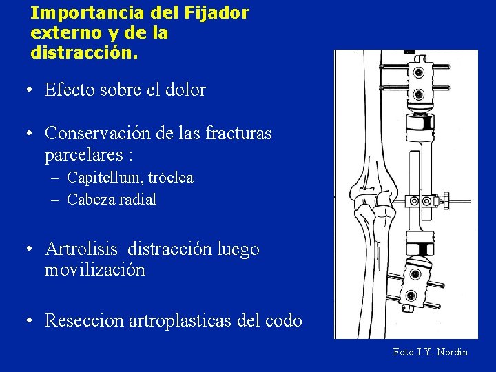 Importancia del Fijador externo y de la distracción. • Efecto sobre el dolor •