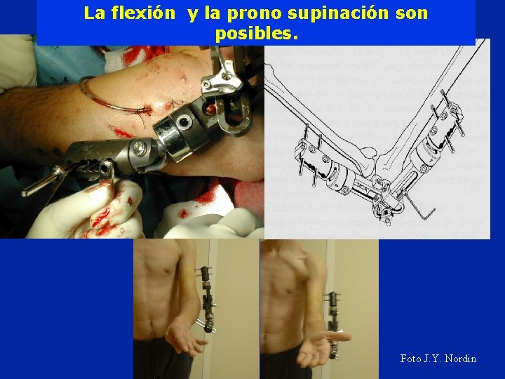 La flexión y la prono supinación son posibles. Foto J. Y. Nordin 