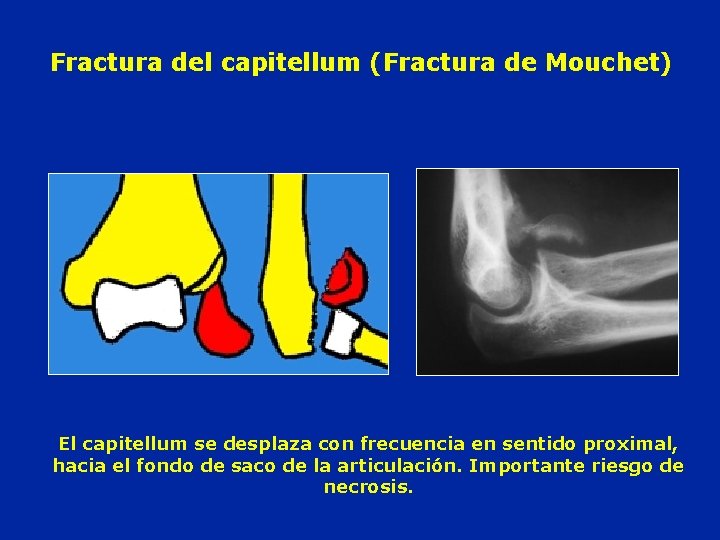 Fractura del capitellum (Fractura de Mouchet) El capitellum se desplaza con frecuencia en sentido
