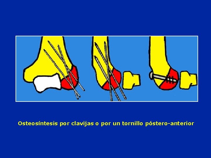 Osteosíntesis por clavijas o por un tornillo póstero-anterior 