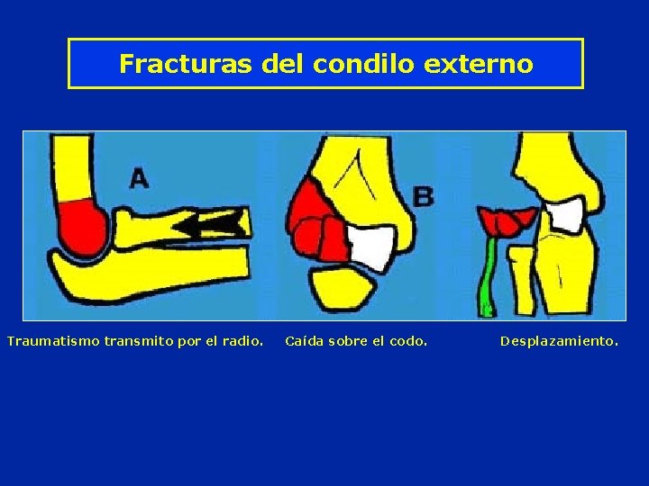 Fracturas del condilo externo Traumatismo transmito por el radio. Caída sobre el codo. Desplazamiento.