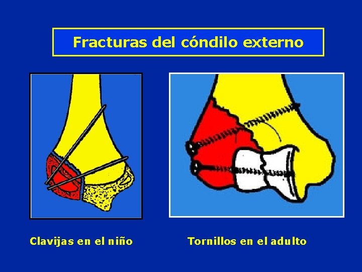 Fracturas del cóndilo externo Clavijas en el niño Tornillos en el adulto 