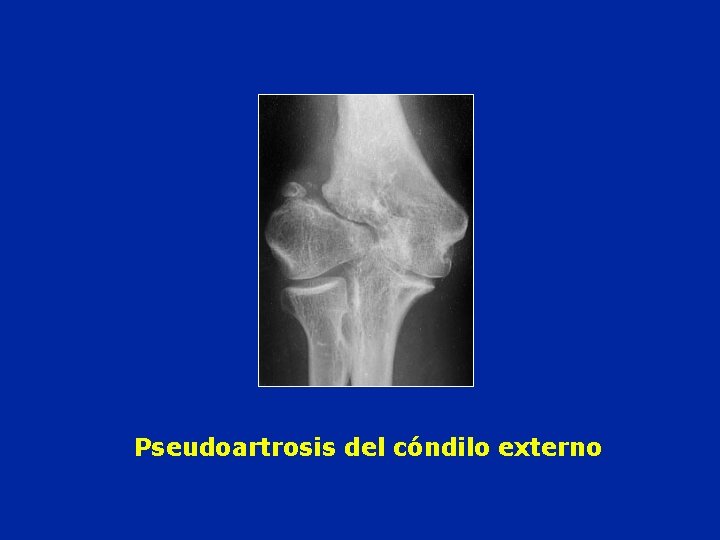 Pseudoartrosis del cóndilo externo 