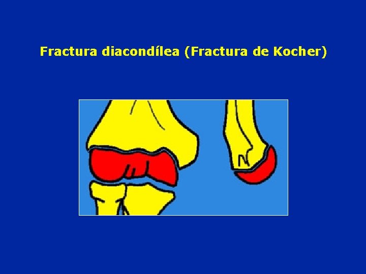Fractura diacondílea (Fractura de Kocher) 