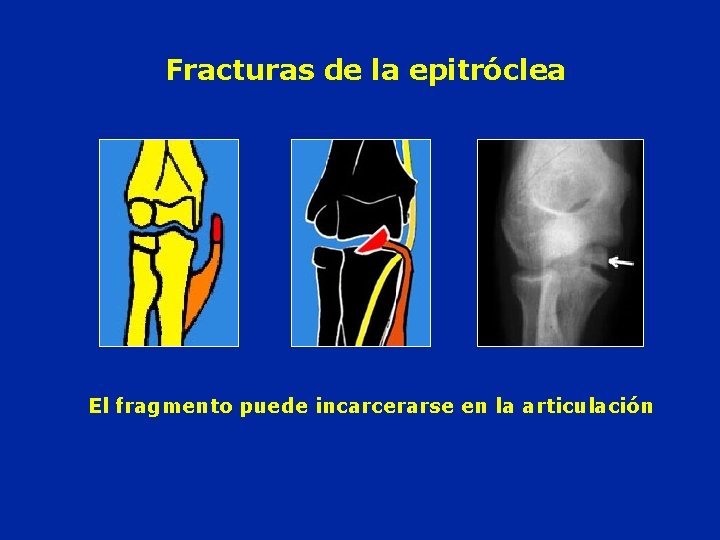 Fracturas de la epitróclea El fragmento puede incarcerarse en la articulación 