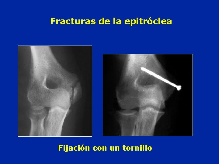 Fracturas de la epitróclea Fijación con un tornillo 