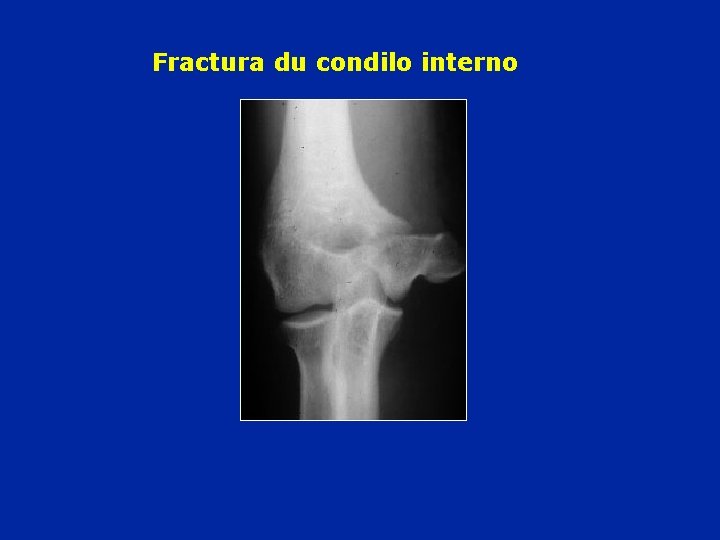 Fractura du condilo interno 