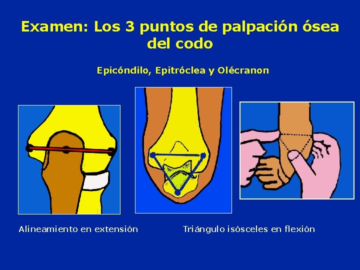 Examen: Los 3 puntos de palpación ósea del codo Epicóndilo, Epitróclea y Olécranon Alineamiento