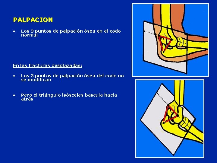 PALPACION • Los 3 puntos de palpación ósea en el codo normal En las