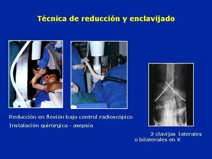 Técnica de reducción y enclavijado Reducción en flexión bajo control radioscópico Instalación quirúrgica -