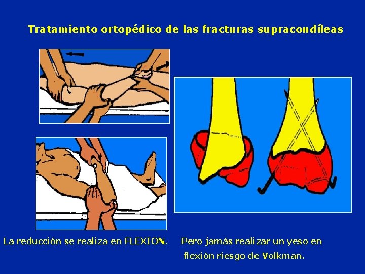 Tratamiento ortopédico de las fracturas supracondíleas La reducción se realiza en FLEXION. Pero jamás