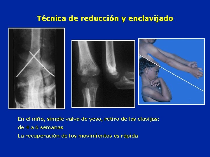 Técnica de reducción y enclavijado En el niño, simple valva de yeso, retiro de