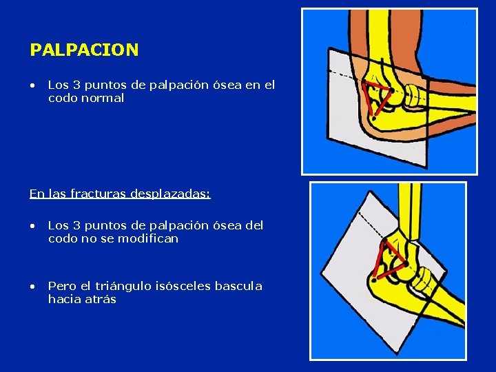 PALPACION • Los 3 puntos de palpación ósea en el codo normal En las