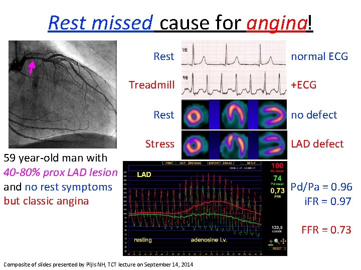 Rest missed cause for angina! Rest Treadmill Rest 59 year-old man with 40 -80%