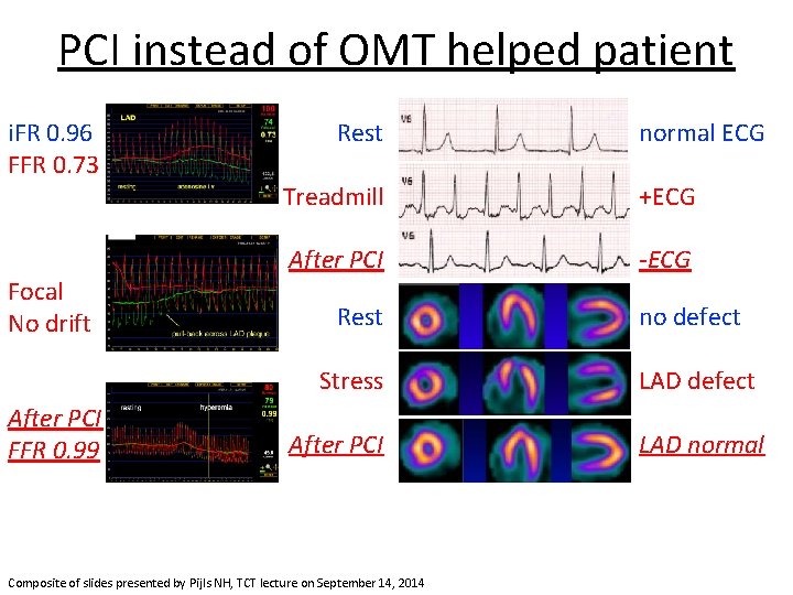 PCI instead of OMT helped patient i. FR 0. 96 FFR 0. 73 Focal