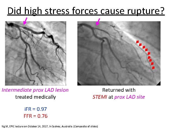 Did high stress forces cause rupture? Intermediate prox LAD lesion treated medically Returned with