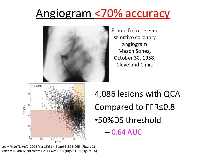 Angiogram <70% accuracy Frame from 1 st ever selective coronary angiogram Mason Sones, October