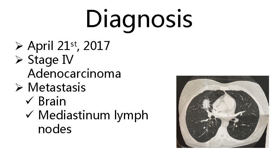 Diagnosis Ø April 21 st, 2017 Ø Stage IV Adenocarcinoma Ø Metastasis ü Brain