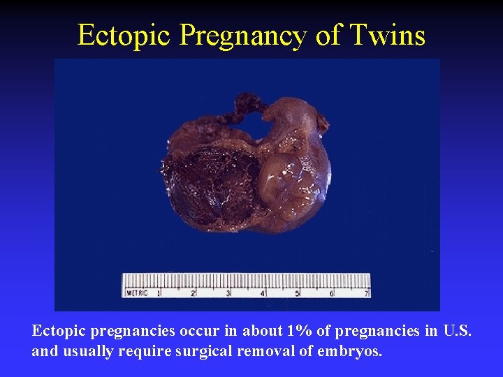 Ectopic Pregnancy of Twins Ectopic pregnancies occur in about 1% of pregnancies in U.