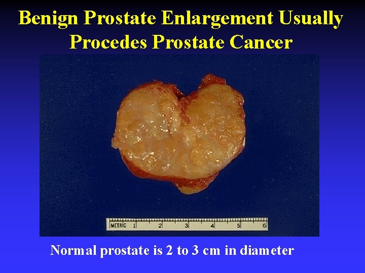 Benign Prostate Enlargement Usually Procedes Prostate Cancer Normal prostate is 2 to 3 cm